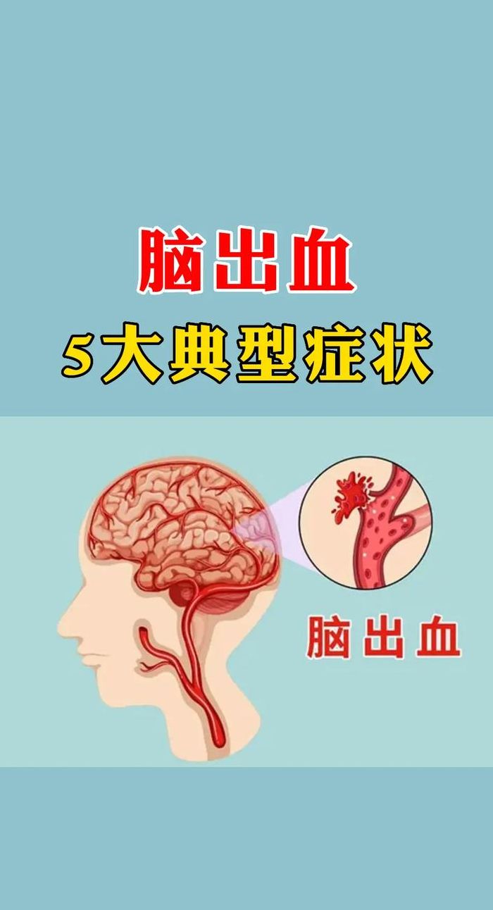 脑出血前兆（脑出血前兆是什么症状）