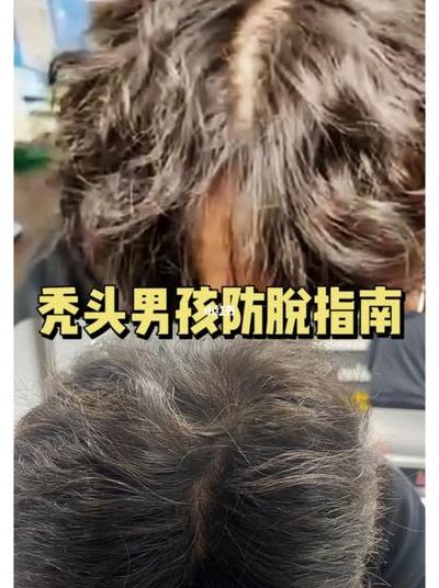 男子秃顶半月不用洗发水后长出头发（脱发不洗头行不行）