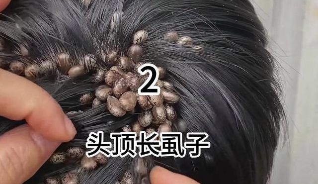 头上长虱子（头上长虱子是什么样子图片）